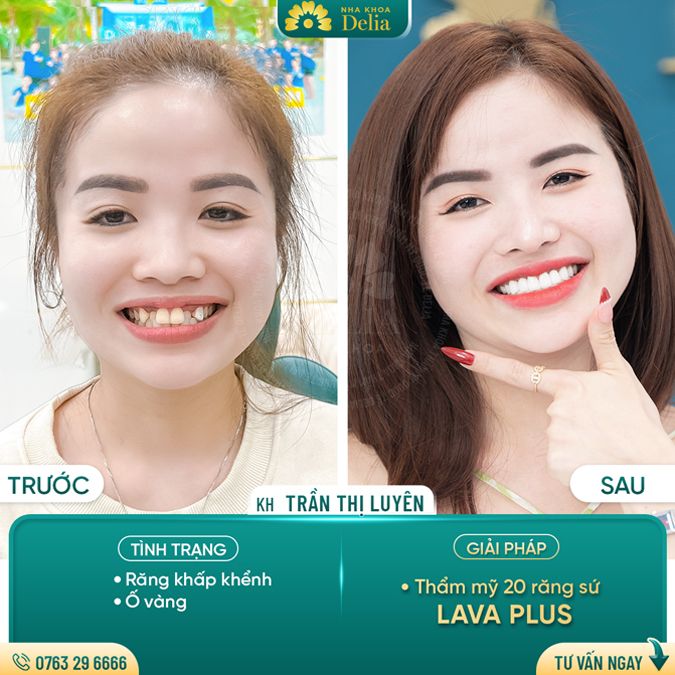 99+ Dáng răng sứ "độc bản" tại nha khoa Delia