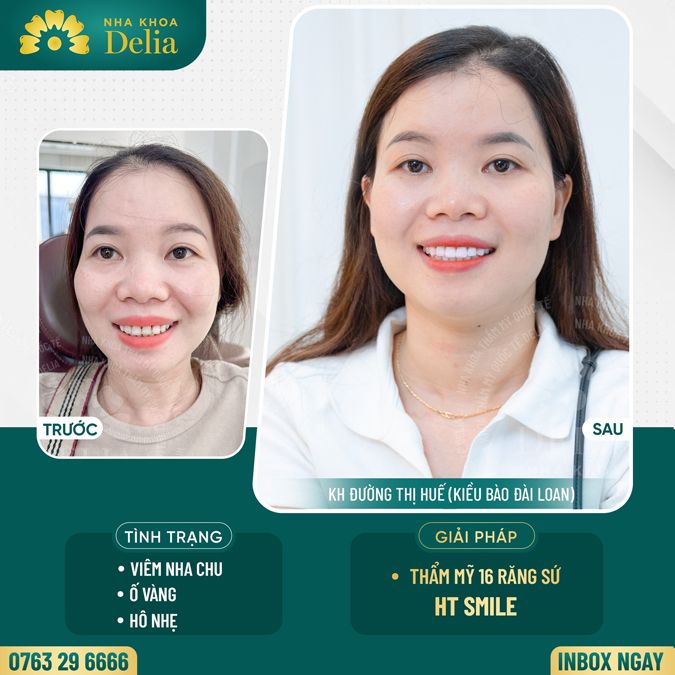 99+ Dáng răng sứ "độc bản" tại nha khoa Delia