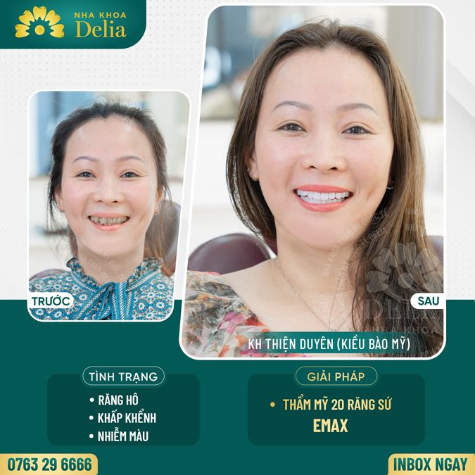 99+ Dáng răng sứ "độc bản" tại nha khoa Delia