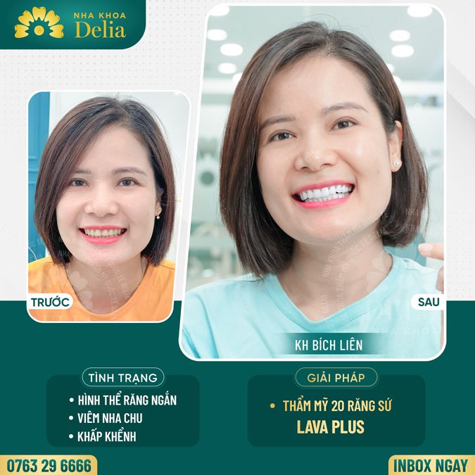 99+ Dáng răng sứ "độc bản" tại nha khoa Delia