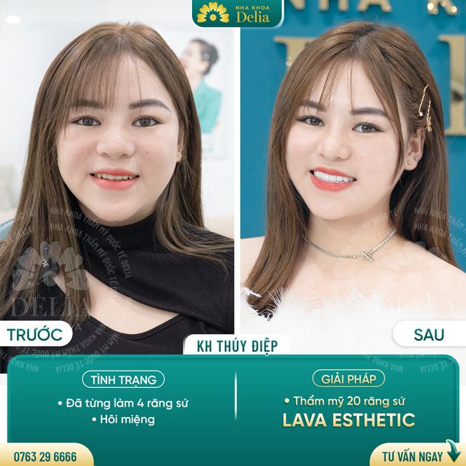 99+ Dáng răng sứ "độc bản" tại nha khoa Delia
