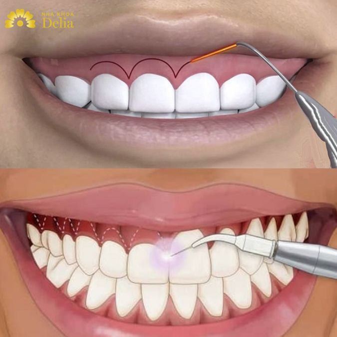 Cắt lợi hay cắt nướu thẩm mỹ là phương pháp làm lộ thân răng, giúp răng nhìn dài hơn