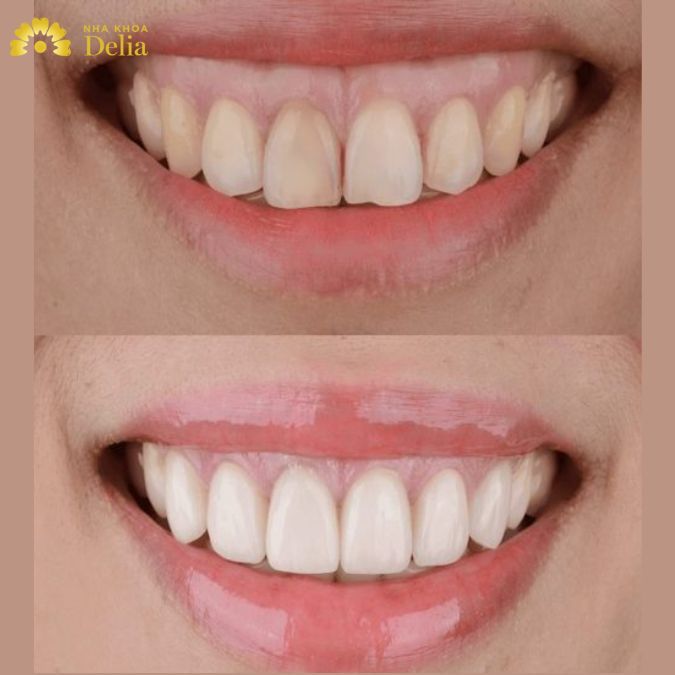 Cắt lợi thẩm mỹ là một trong những phương pháp cải thiện thẩm mỹ đáng kể cho nụ cười của bạ