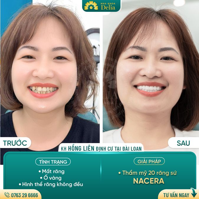 99+ Dáng răng sứ "độc bản" tại nha khoa Delia