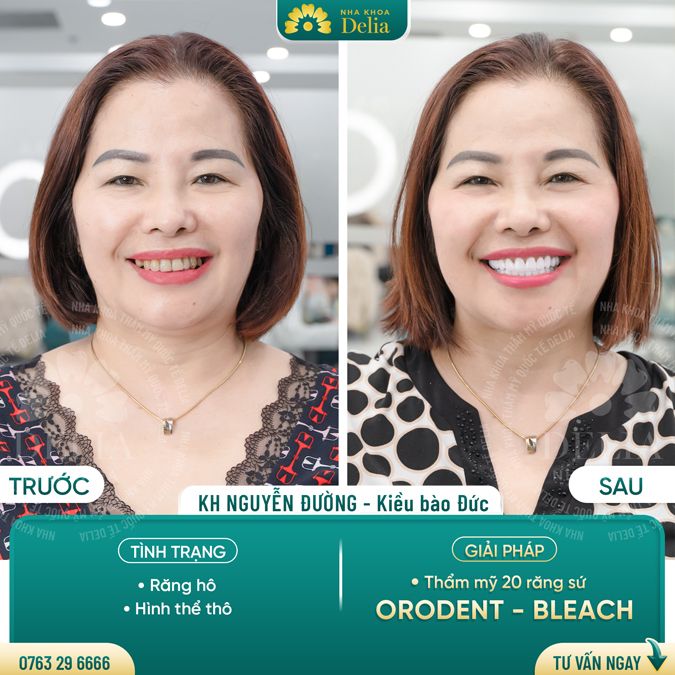 99+ Dáng răng sứ "độc bản" tại nha khoa Delia