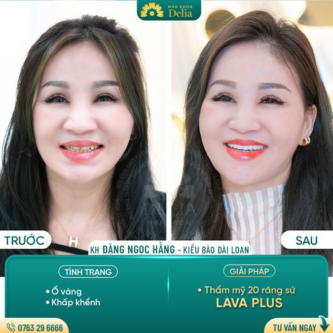 99+ Dáng răng sứ "độc bản" tại nha khoa Delia