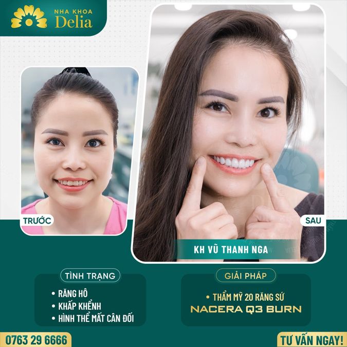 99+ Dáng răng sứ "độc bản" tại nha khoa Delia