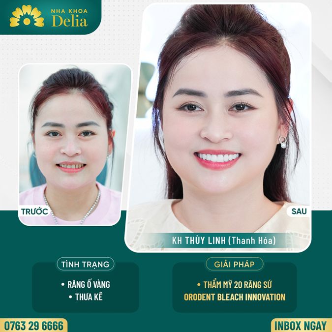 99+ Dáng răng sứ "độc bản" tại nha khoa Delia