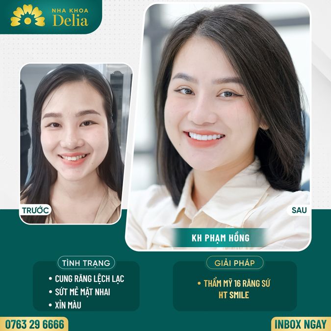 99+ Dáng răng sứ "độc bản" tại nha khoa Delia