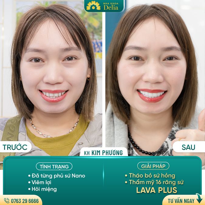 99+ Dáng răng sứ "độc bản" tại nha khoa Delia