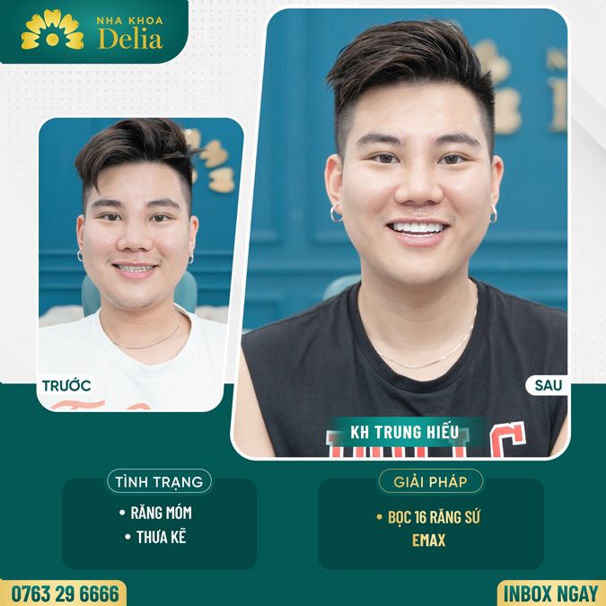 99+ Dáng răng sứ "độc bản" tại nha khoa Delia