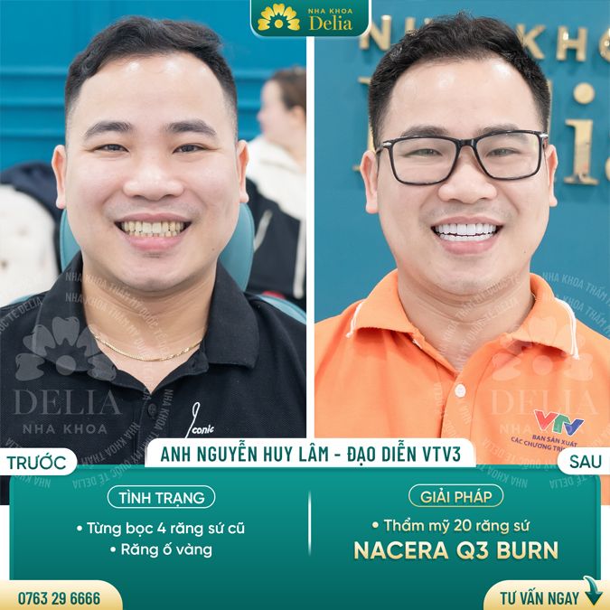 99+ Dáng răng sứ "độc bản" tại nha khoa Delia