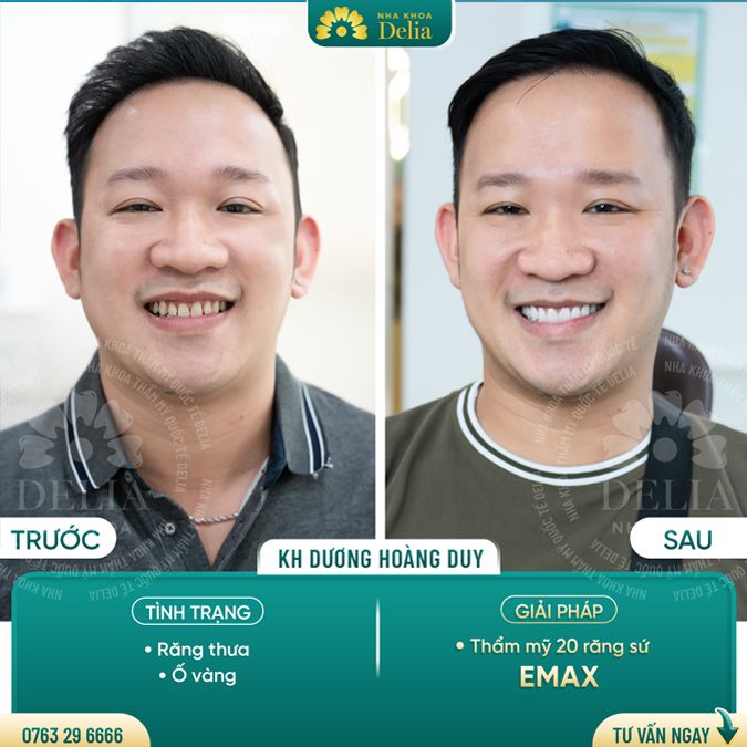 99+ Dáng răng sứ "độc bản" tại nha khoa Delia