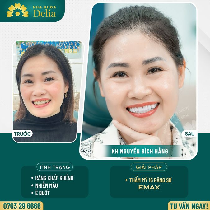 99+ Dáng răng sứ "độc bản" tại nha khoa Delia