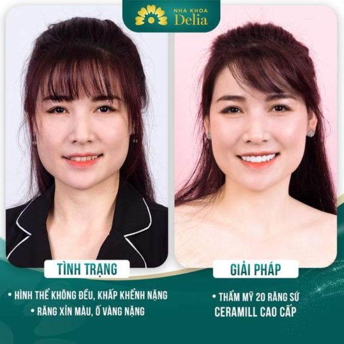 Chị Hương- thẩm mỹ răng sứ Ceramill: "Chị thực sự ưng ý với màu sắc răng sứ sau khi làm. Đặc biệt quá trình làm răng không dau và bác sĩ rất chu đáo."