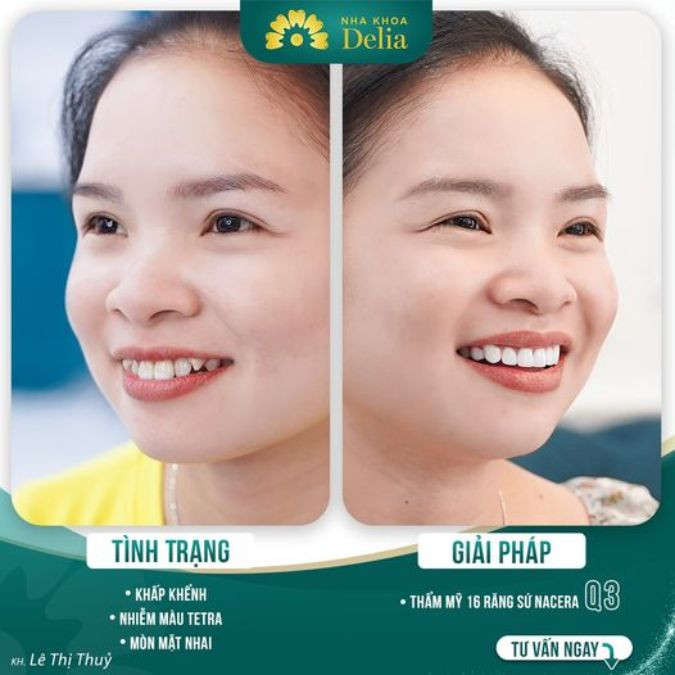 Chị Thủy: "Cảm ơn đội ngũ bác sĩ nha khoa Delia đã giúp chị có được nụ cười sáng 10 điểm."