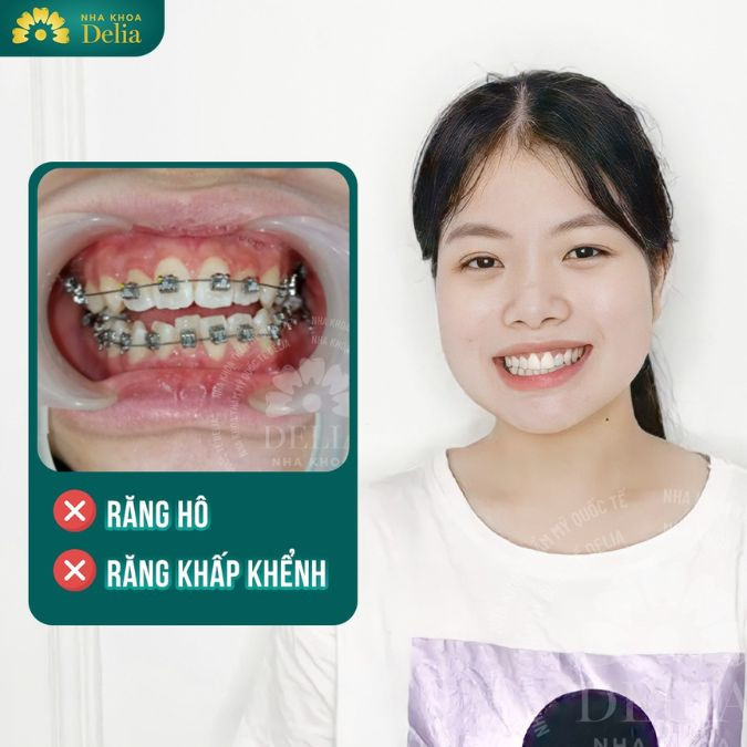 Răng hô nên niềng răng chỉnh nha