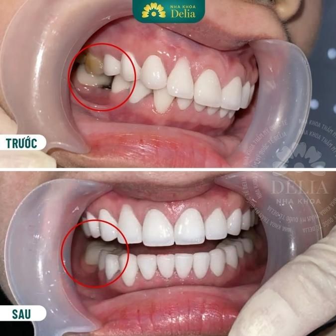 Tại sao khi mất răng nên đi trồng răng Implant càng sớm càng tốt?
