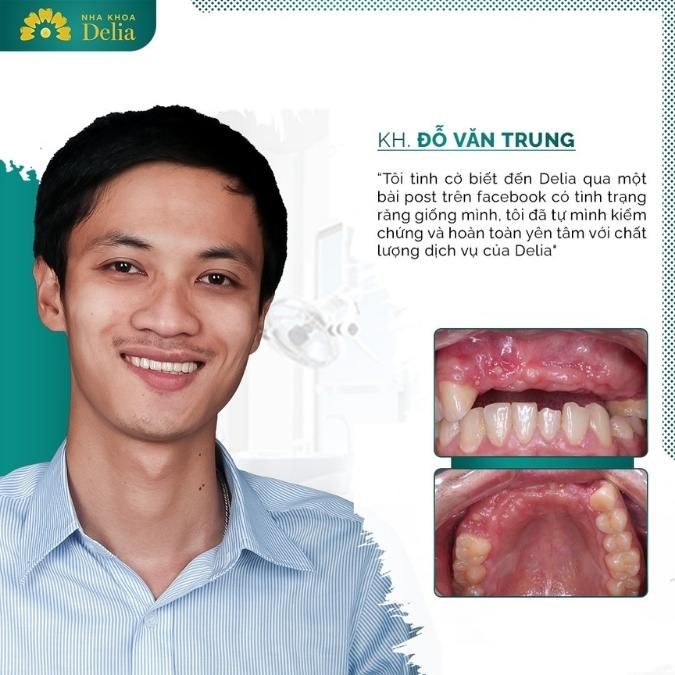 Cảm nhận của khách hàng trồng răng Implant tại nha khoa Delia
