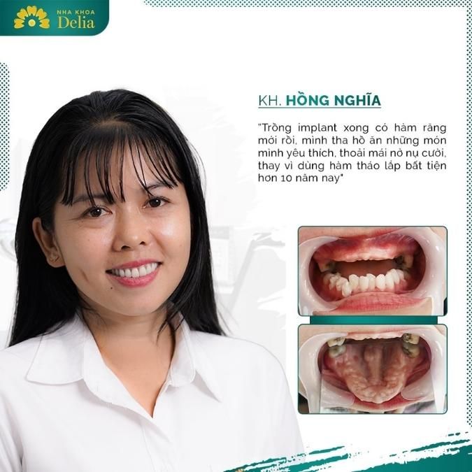 Cảm nhận của khách hàng trồng răng Implant tại nha khoa Delia
