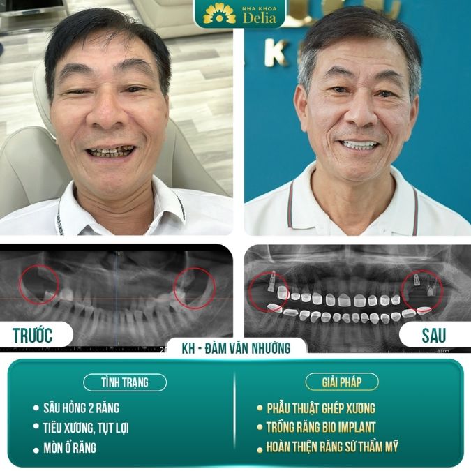 Trồng răng Implant mất nhiều răng