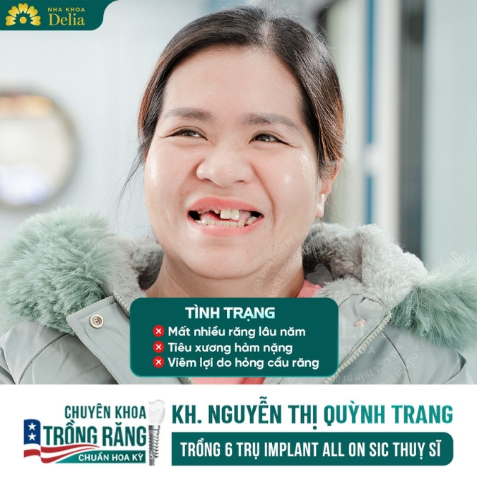Trồng răng Implant mất nhiều răng là phương pháp gì?