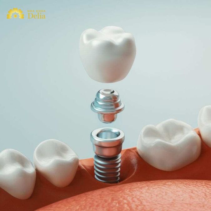 Trồng răng Implant mất nhiều răng có hiệu quả hơn cầu răng sứ không?
