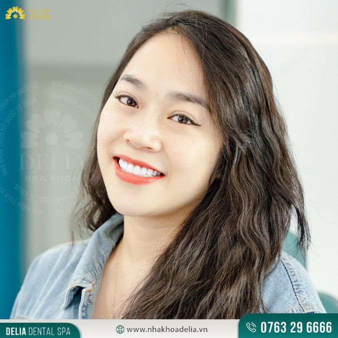 Chị Phí Mai: "Giờ có nụ cười rạng rỡ chị hoàn toàn ưng ý. Bác sĩ Delia vừa trẻ vừa có tay nghề cao, gu thẩm mỹ không có điểm nào để chê cả. Khác hoàn toàn so với các bác sĩ ở bên Anh. Đợt này về, không chỉ có chị về làm răng sứ mà các chị em nhà chị cũng đến Delia để làm răng".