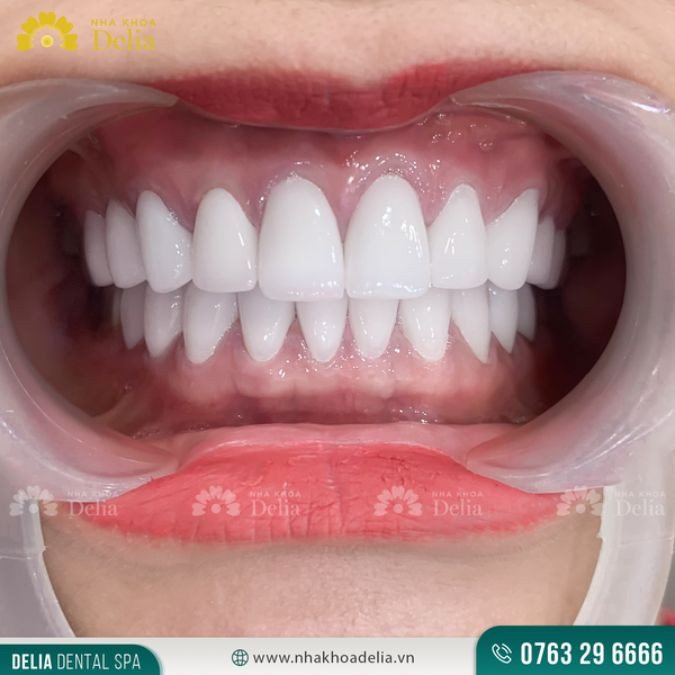 18 tuổi mới nên cân nhắc bọc răng sứ