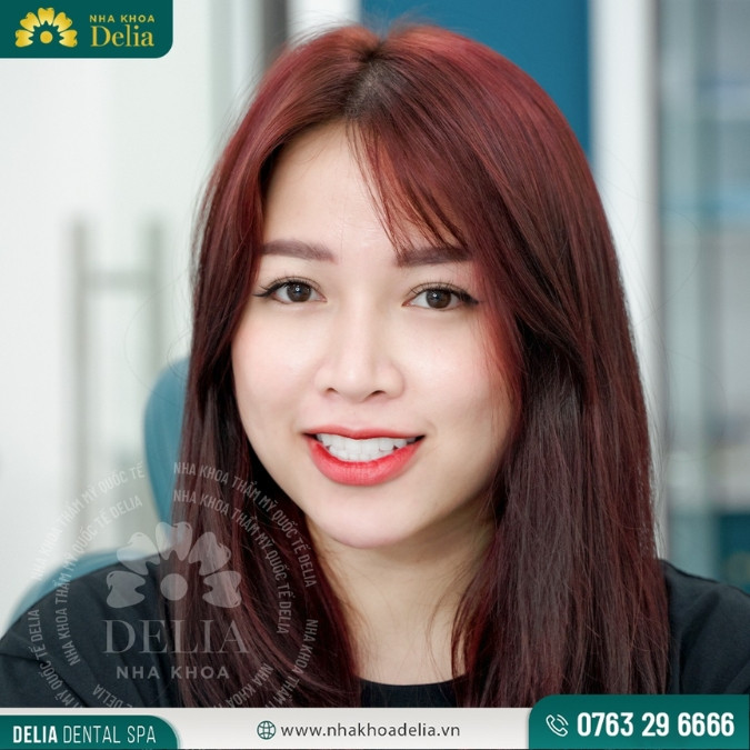 Trường hợp nào 15 tuổi có thể bọc răng sứ thẩm mỹ?