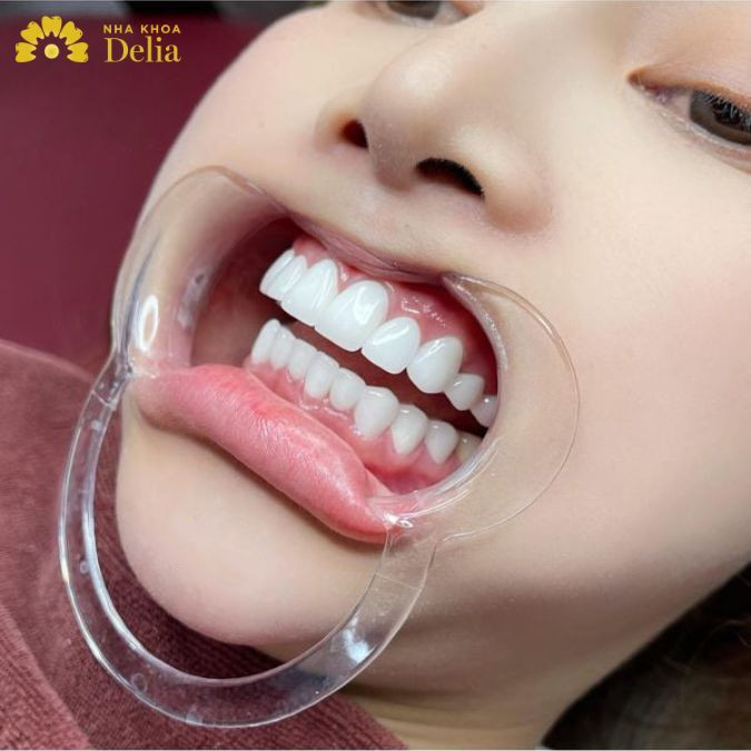 Bọc sứ nên được thực hiện khi đã đủ 18 tuổI
