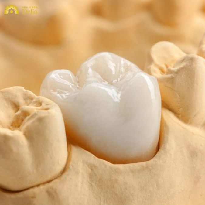Răng toàn sứ với độ bền có thể lên tới 20 năm
