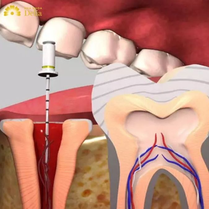 Răng sâu nghiêm trọng ảnh hưởng tới tủy không nên bọc sứ