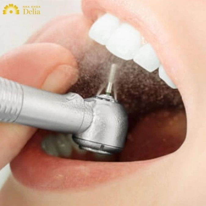 Sau khi mài răng sứ cần phải chăm sóc răng miệng kỹ lưỡng