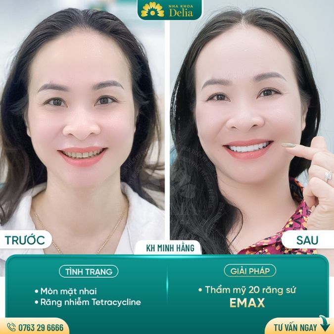 Bọc sứ răng cửa bao nhiêu tiền? Răng cửa bị tổn thương gây ra hậu quả gì?