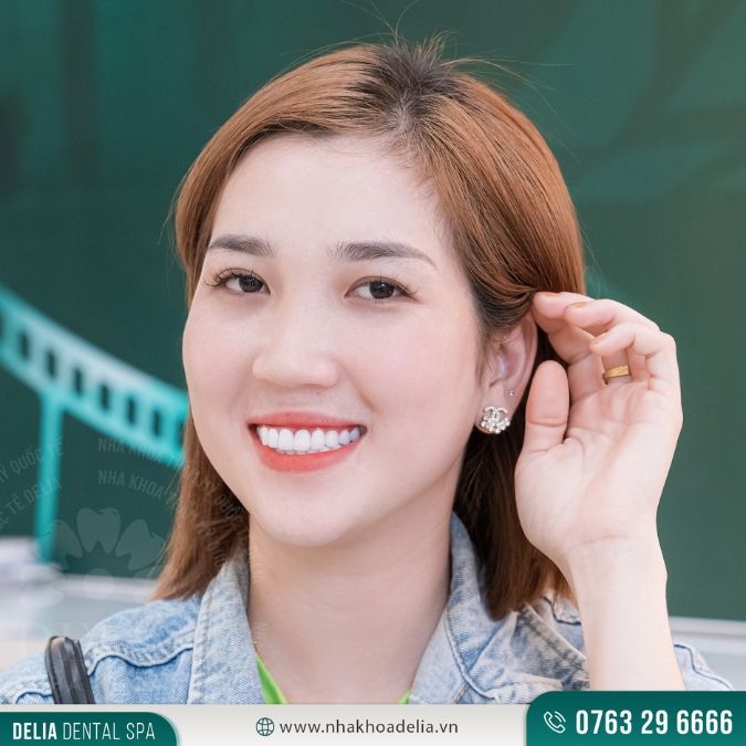 Bọc sứ răng cửa bao nhiêu tiền
