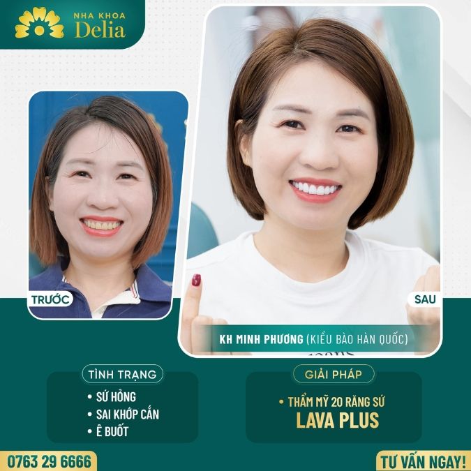 Bọc sứ răng cửa bao nhiêu tiền? Nên dùng loại sứ nào bọc sứ cho răng cửa?