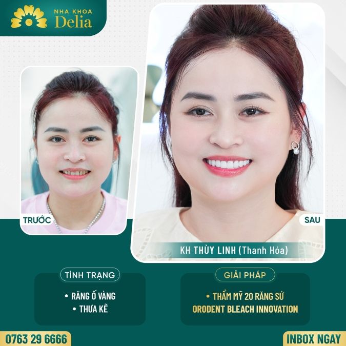 Răng cửa bọc sứ Orodent