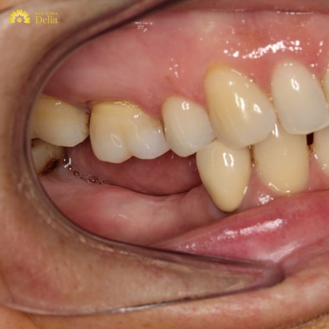 Mất răng số 7 gây ra hậu quả gì? Khi nào thì nên bọc sứ răng số 7