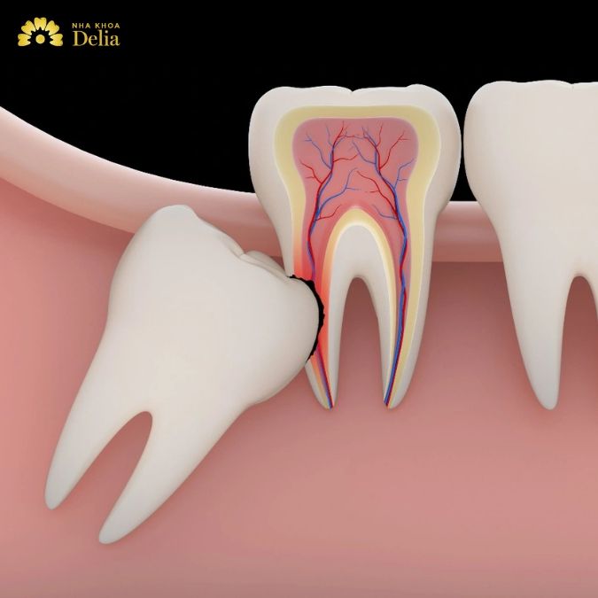 Tại sao răng số 8 gây đau nhức khó chịu? 