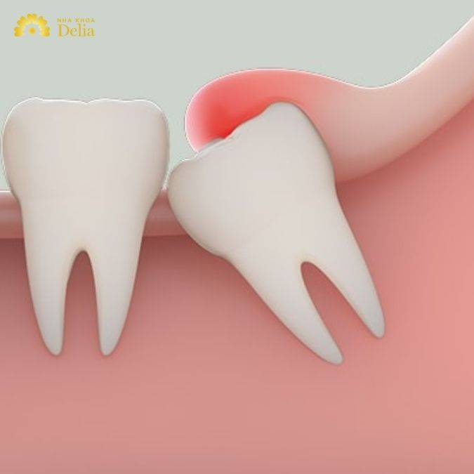 Một số hậu quả khôn lường khi răng số 8 mọc sai cách
