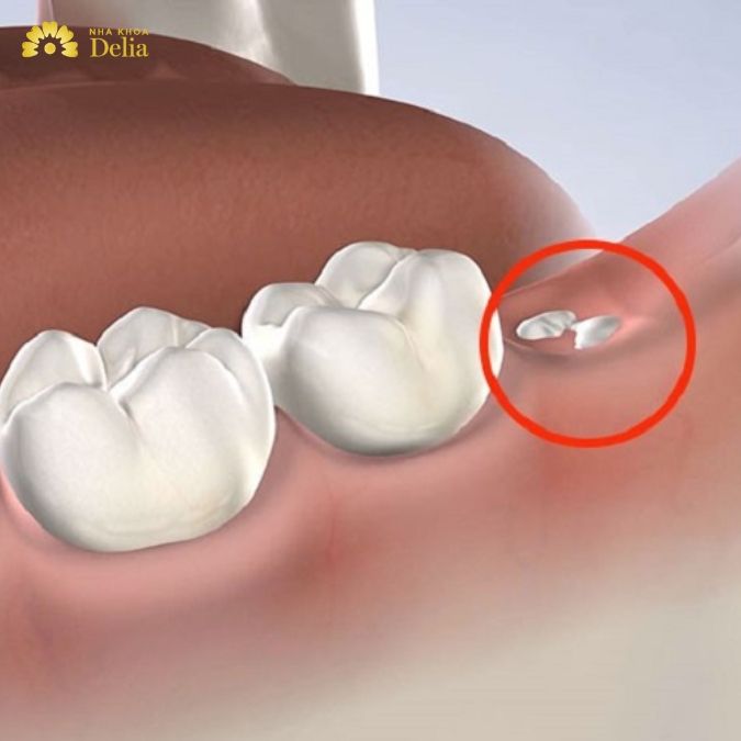 Bọc sứ răng số 8 có phải giải pháp hiệu quả nhất cho mọi tình trạng không?