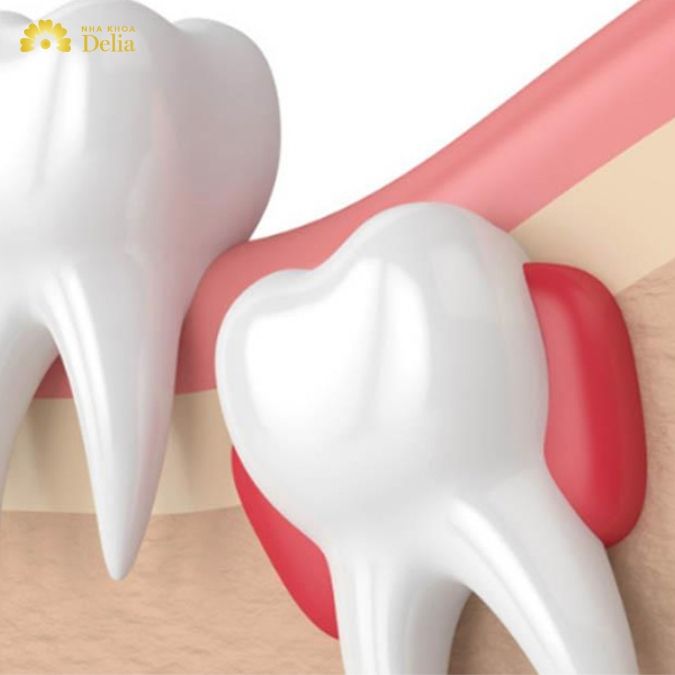 Có nên bọc răng sứ khi răng số 8 bị tổn thương không?