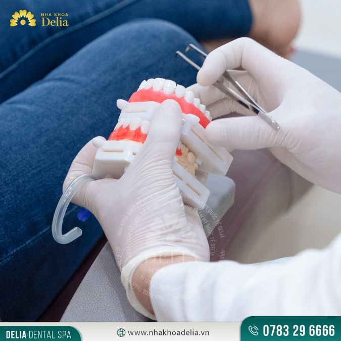 Có nên bọc răng sứ khi răng số 8 bị tổn thương không?