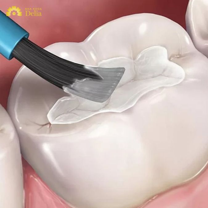 Có nên bọc răng sứ khi răng số 8 bị tổn thương không?