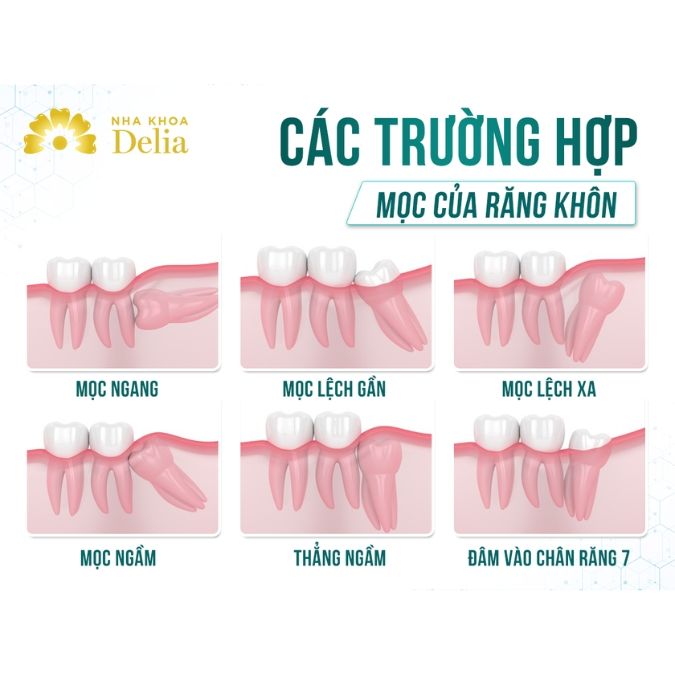 Tại sao răng số 8 gây đau nhức khó chịu? 