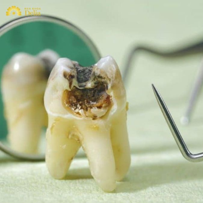 Tại sao răng số 8 gây đau nhức khó chịu? 