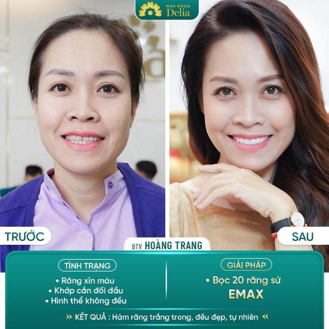 BTV Hoàng Trang trước và sau khi thẩm mỹ răng sứ Emax