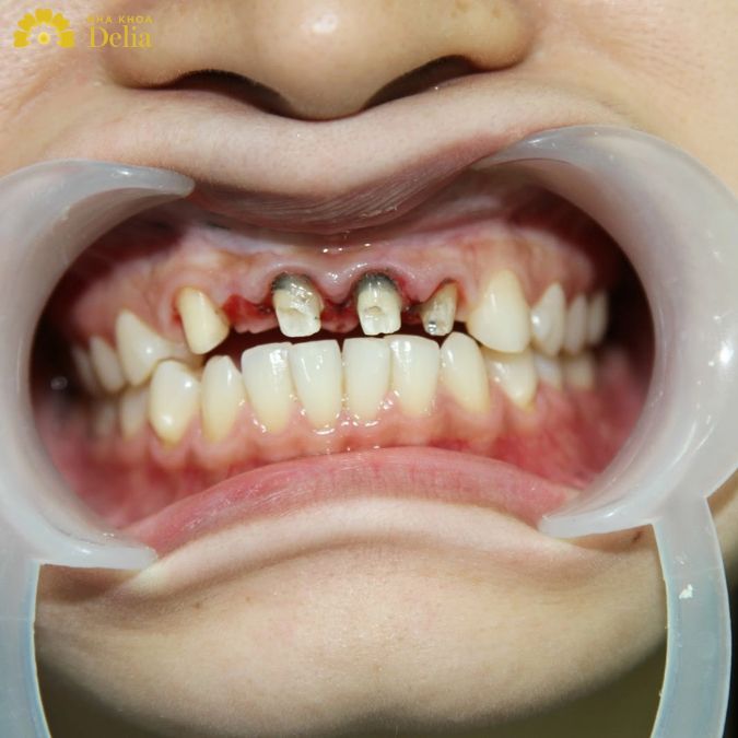 Hạn chế chân răng bị đen bằng cách chăm sóc răng miệng đúng cách