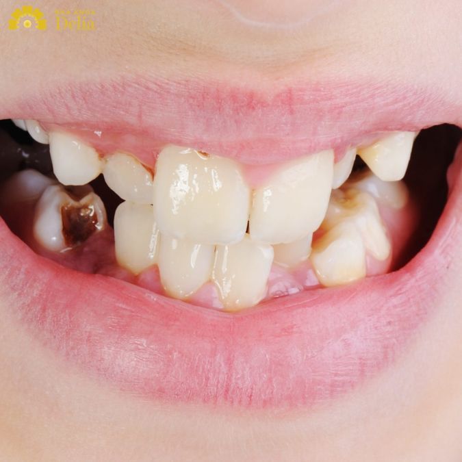 Đen chân răng gây ra nhiều bệnh lý nghiệm trọng